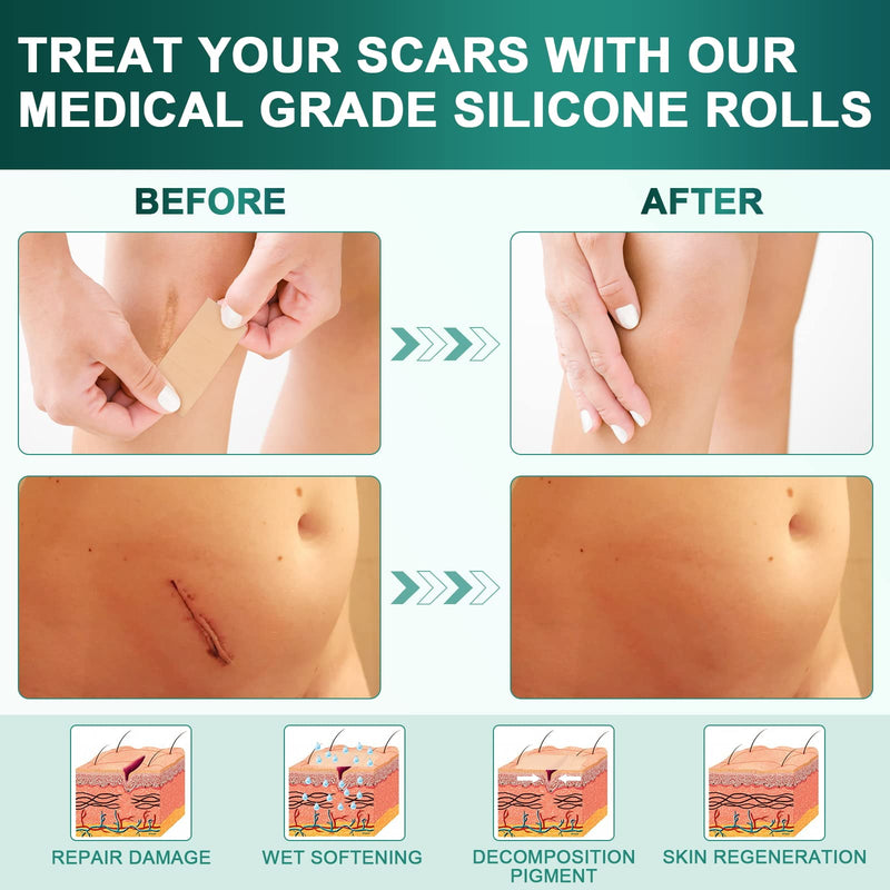 [Australia] - Silicone Scar Sheets,Silicone Scar Tape(1.6"x 120" Roll-3M), Reusable and Effective Scar Removal Sheets, Silicone Scar Removal Sheets for Surgical Scars,Healing Keloid, C-Section, Tummy Tuck 1.6"x 120" Roll 