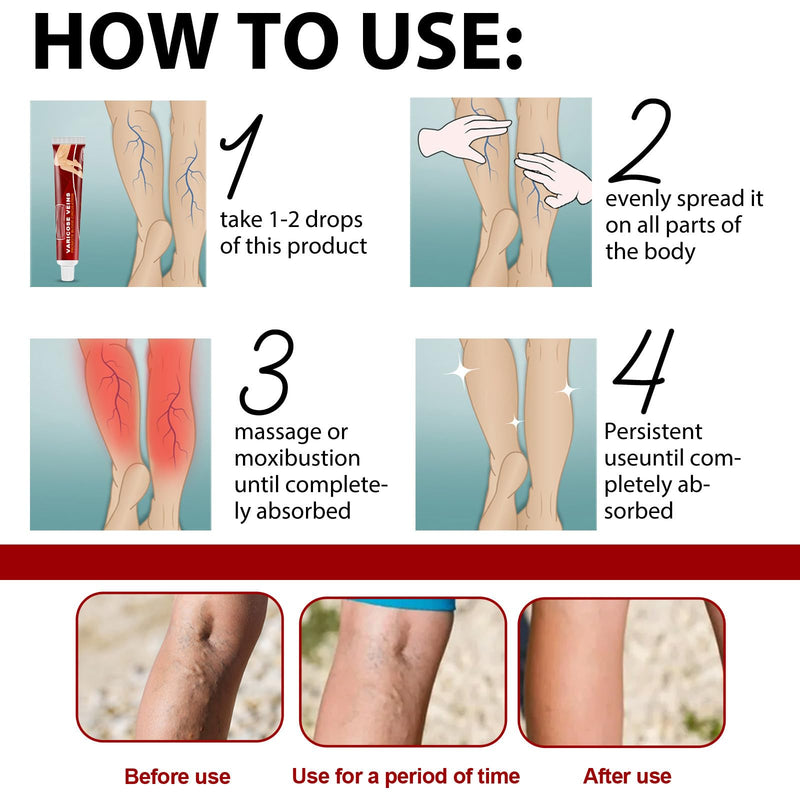 [Australia] - Grgowe Varicose Veins Cream, Varicose Veins Cream, Cream for Spider Veins, Active Veins, Anti-Varicose Veins Cream, Cream for Relieving and Preventing Varicose Veins, Improve Blood Circulation for Legs 