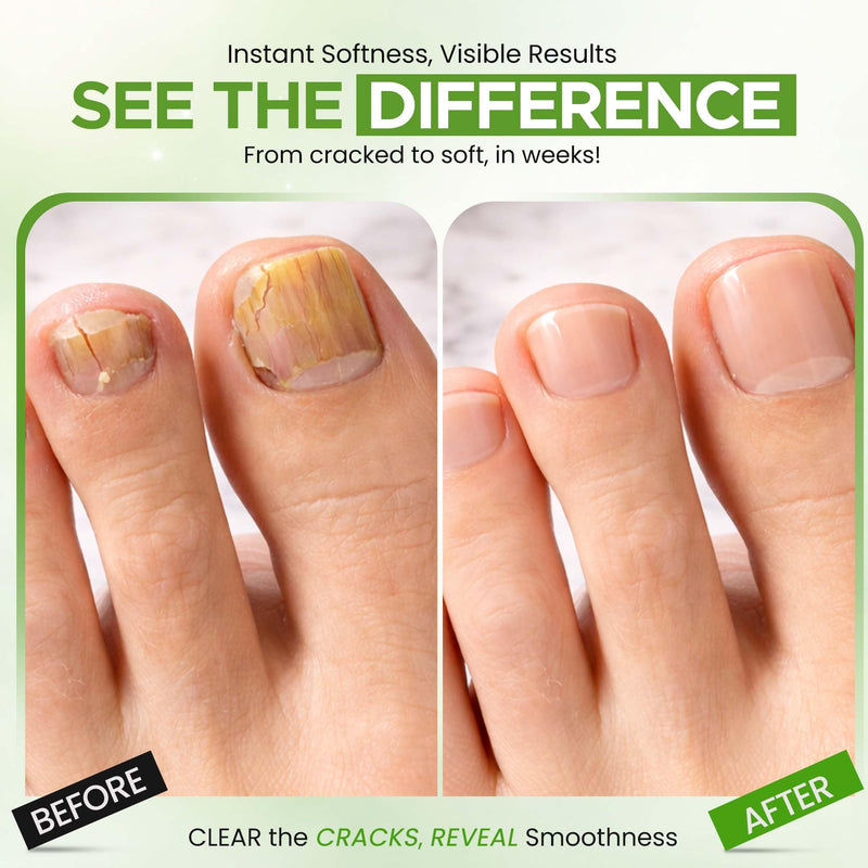 CLEAR Urea Nail Gel with Tea Tree Oil Made in USA, Night Time Formula | Urea Nail Gel Softens, Hydrates & Repairs Nails –Urea Gel with Fast & Visible Results, Trusted by Health Professionals Green Tea Tree