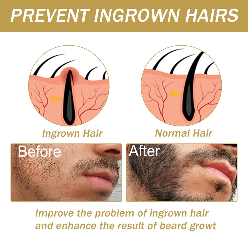 [Australia] - Beard growth kit, beard growth set with derma roller, beard growth serum oil/beard roller, beard growth kit, stimulates mustache and hair growth, gifts for men, father, black 