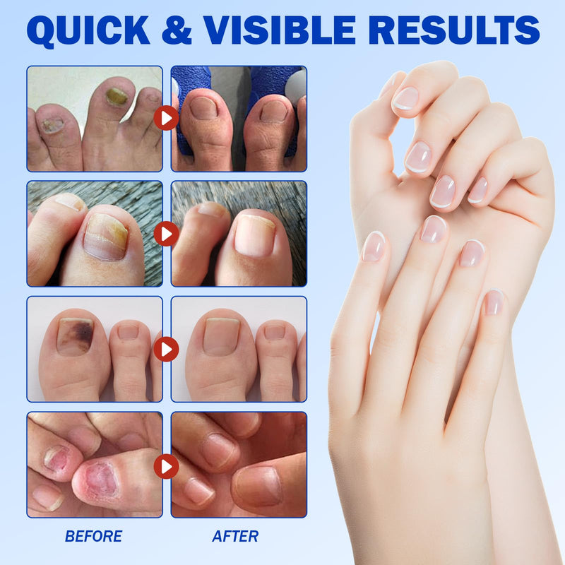 Nail Patches for Toenails, 42PCS Hydrogel Nail Care Patches, Overnight Nail Support & Protection, Easy to Apply for Toenail & Fingernail 21 Count (Pack of 2)