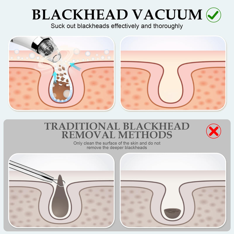 Blackhead Vacuum Removers - Pore Vacuum for Face with 5 Attachments & 3 Suction Levels - USB Rechargeable Blackhead Remover Tools for Women and Men (White)
