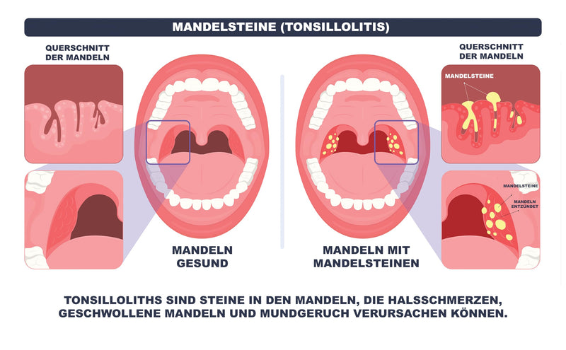 [Australia] - La River Kit Tonsil Stone Remover Tonsil Stones Removal Tonsil Stone With LED Light 