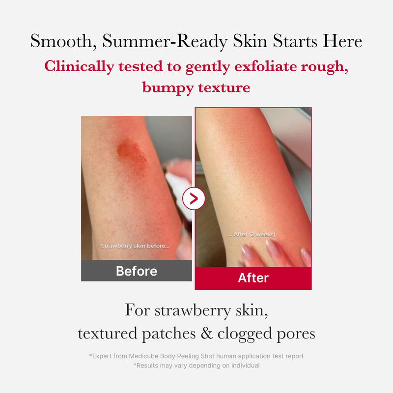 [Australia] - medicube Red Body Peeling Shot, AHA + BHA Exfoliating Body Spray for Summer-Ready Smooth Skin, Treats Strawberry Skin, Bumps & Breakouts, 3.88 oz 