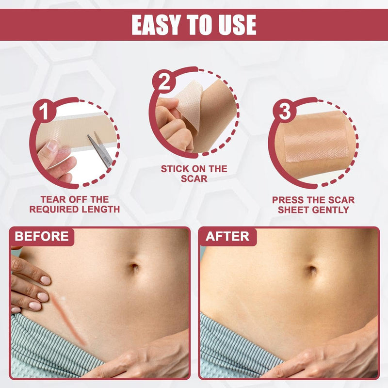 [Australia] - WROLY Silicone Scar Sheets, Keloid Scars Tape, Silicone Scar Tape for Surgical Scars, Keloid Bump Removal, C-Section Silicone Scar Removal Strips for Surgical, Tummy Tuck (1.5M) 1.5M 