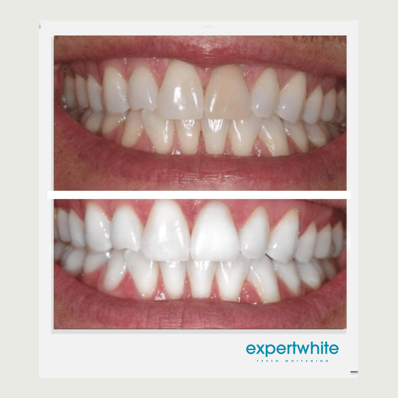 [Australia] - Extreme 44% Teeth Whitening Gel (6-gels) 