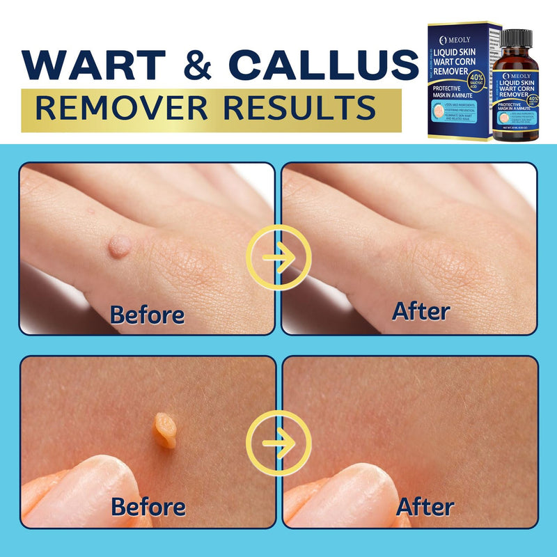 [Australia] - Fast-Acting Wart Remover: 40% Salicylic Acid Wart Remover Maximum Strength for Plantar Wart, Corn Men and Women 