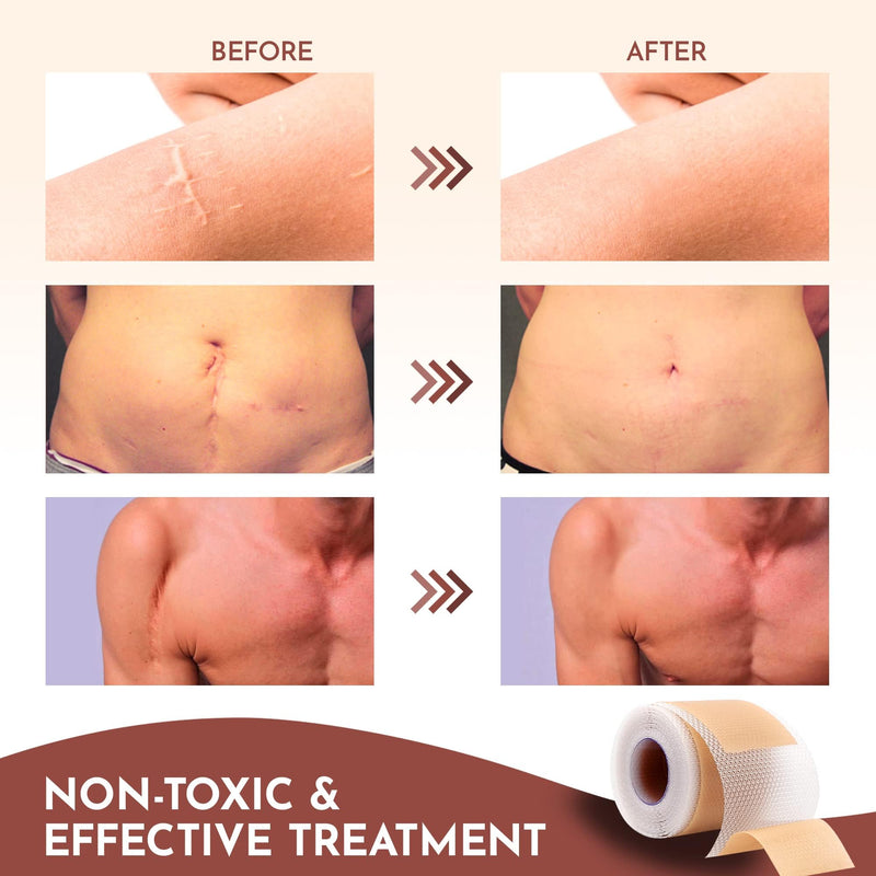[Australia] - Silicone Scar Sheets - Silicone Scar Tape (1.6"x 120" Roll-3M) - keloid bump removal - Reusable And Effective Scar Removal Strips - Silicone Tape for Scars, Keloid, C-Section, Acne et 