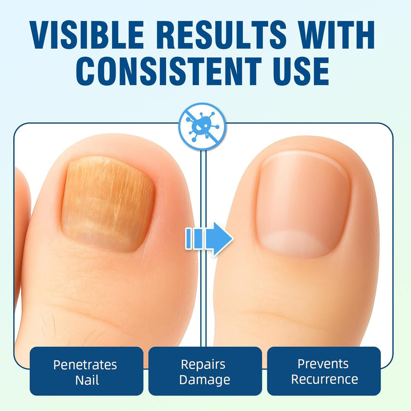 [Australia] - Toenail Fungus Treatment Extra Strength with 25% Undecylenic Acid, Ingrown toenail treatment, nail repair, Fungus nail treatment, yellow toenail, Damaged Nails foot fungus treatment extra strength 2 Fl Oz (Pack of 1) 