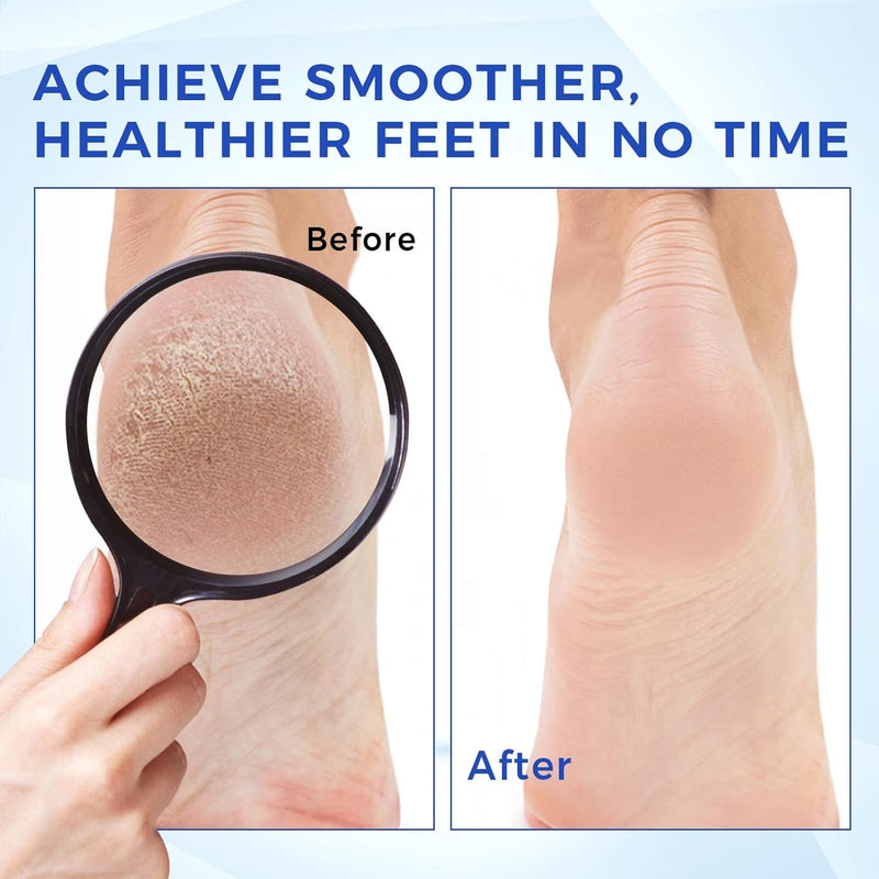 OUKEYA Urea Cream 40 Percent for Foot & Hand Cream with Foot Files for Dry Cracked,Urea Lotion for Feet Maximum Strength