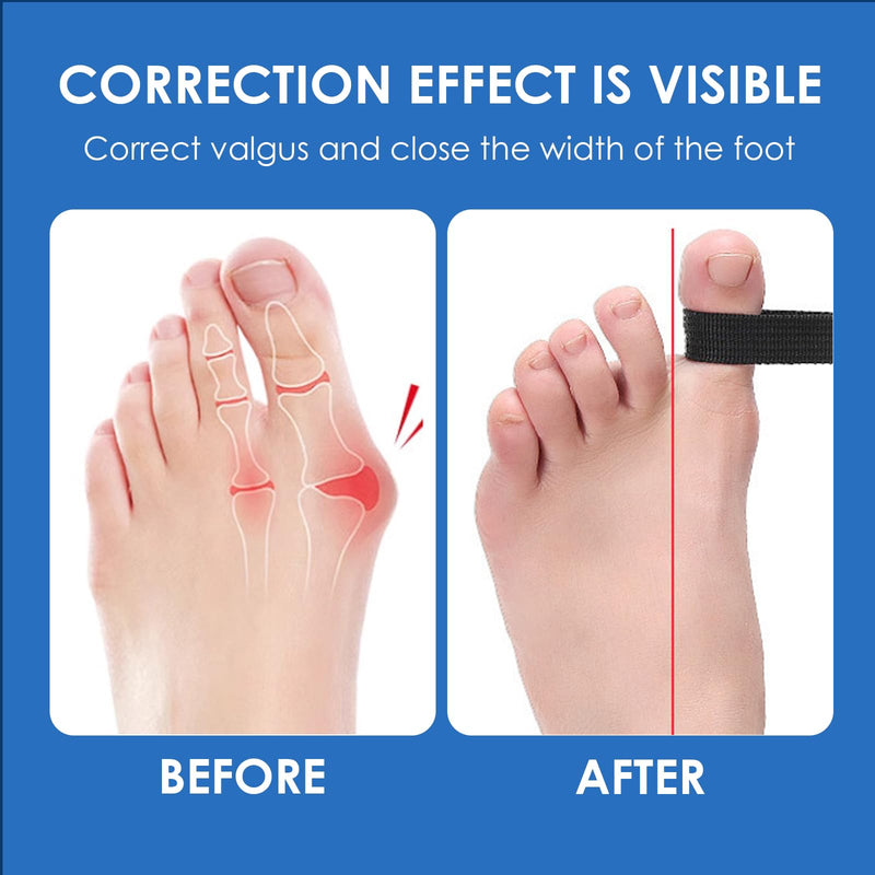 [Australia] - Nacerlary 1 PCS Hallux Valgus Toe Separator Training Band, Toe Separator for Relief, Easy to Use, Correction for Hallux Valgus Bunion for Men and Women 