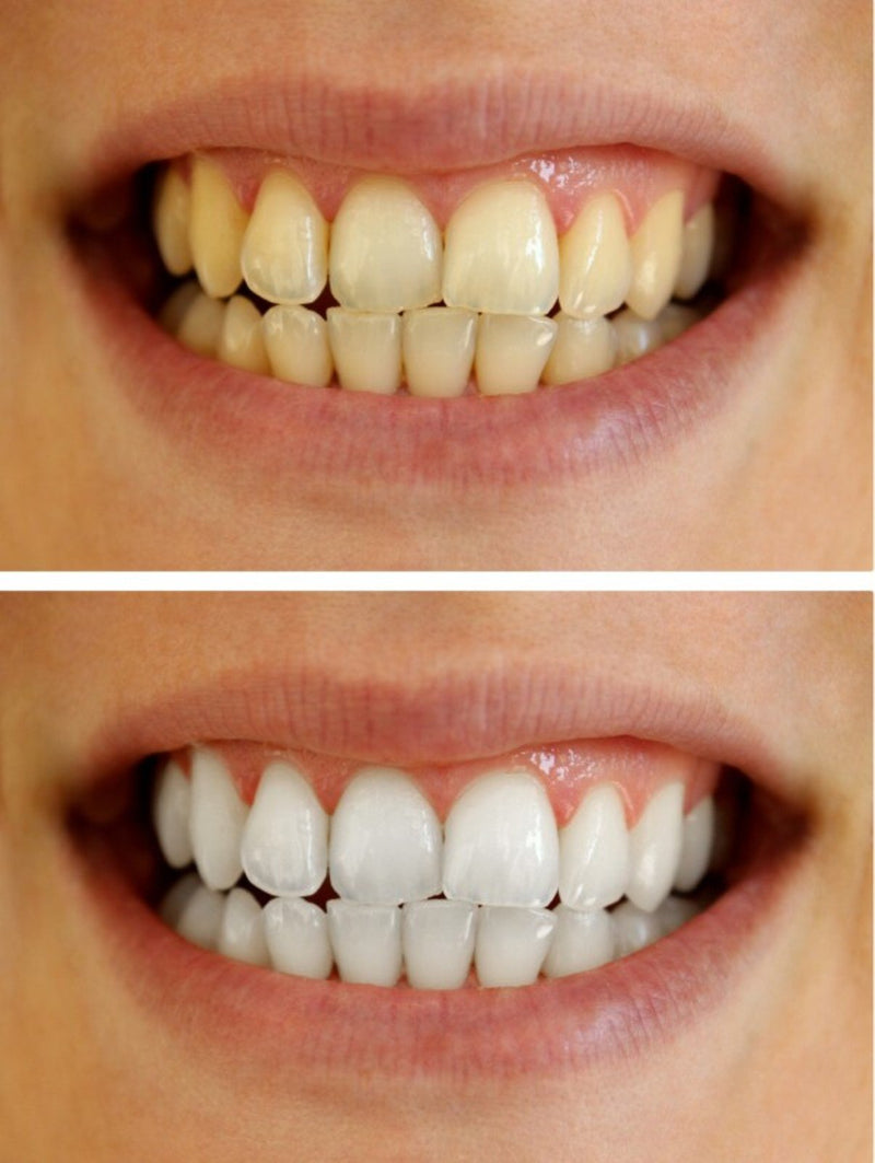 [Australia] - Teeth Whitening Gel Syringe Dispensers 22% Carbamide Peroxide, 10 Tooth Bleaching Gel 3ml Syringes 