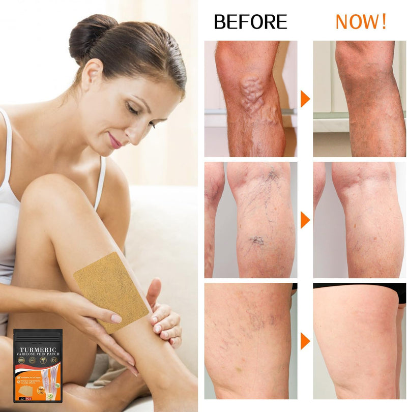 [Australia] - Furzero turmeric varicose vein plaster, Furzero varicose vein plaster, turmeric varicose vein plaster, turmeric plaster for varicose veins, promotes blood circulation (48 PIECES) 