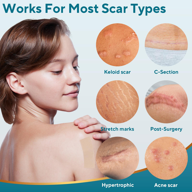 [Australia] - Silicone Scar Sheets, Silicone Scar Tape, Reusable Scar Silicone Strips for Scar Removal Treatment, Soft Silicone Scar Sheets for Surgical Scars, Keloid, C-Section, Burn et(1.6‚Äù x 59‚Äù Roll-1.5M) 1.5M 