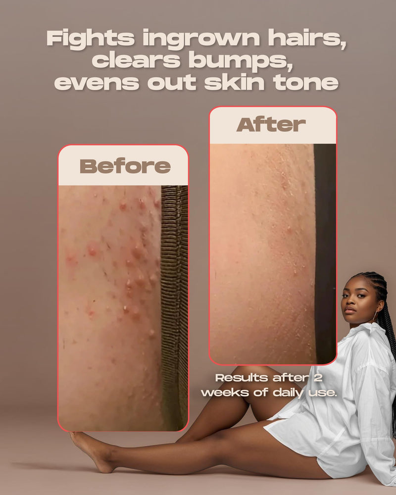 [Australia] - Sugardoh Ingrown Magic Wand - After Wax Serum for Women - Skin Care with Glycolic Acid for Ingrown Hair, Razor Burn & Dark Spots - Exfoliating Treatment for Silky-Smooth Skin 