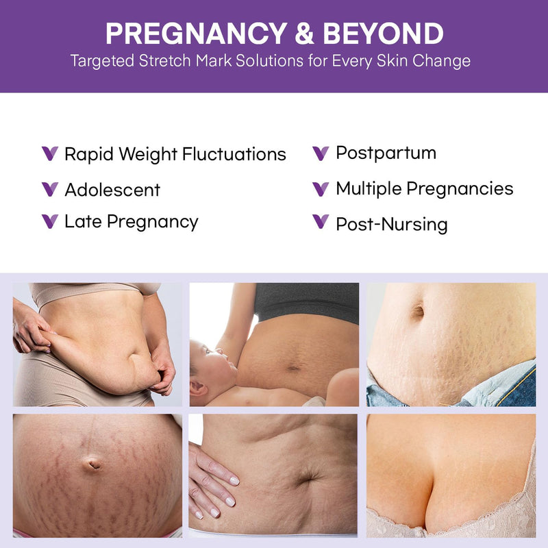 [Australia] - Stretch Mark Cream for Pregnant Women: Stretch Mark Treatment for Pregnancy - Belly Butter For Pregnant Women - Massage Lotion To Prevent And Repair Maternity Stretch Marks Scar - 4 Oz 