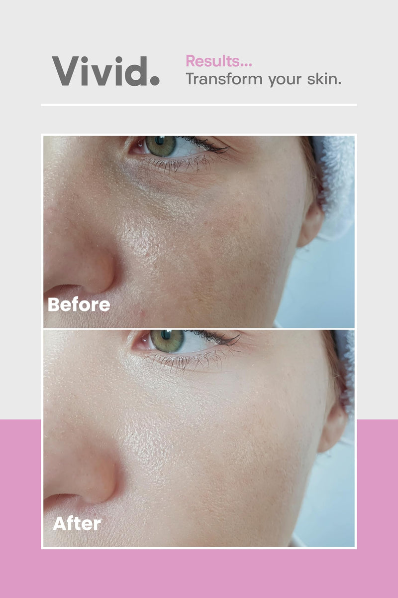 Vivid Dewy Edible Skin Supplement - for Dry Skin - Collagen, Aloe Vera, Vitamin C - 30 day serving