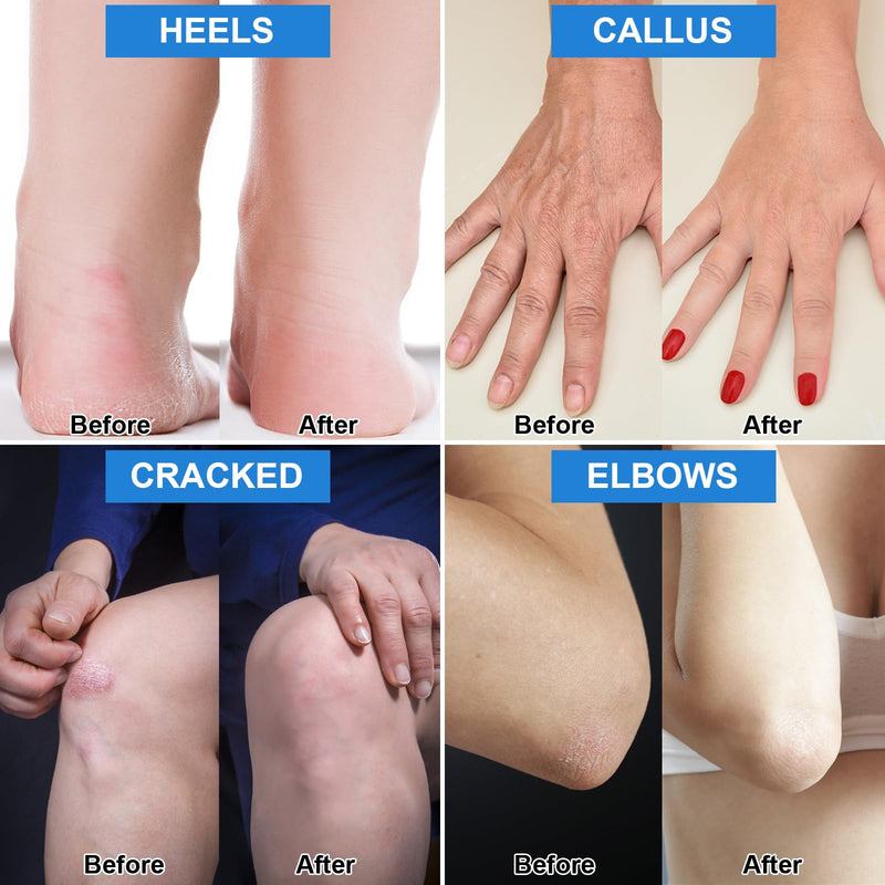 [Australia] - 7.06OZ / 2 Pack Urea Cream 42% Plus Salicylic Acid 2%, Urea Foot Cream for Foot Care Cracked Heel Treatment Knees Elbows Hands Repair Treatment, Feet Moisturizer Corn Callus Dead Skin Deep Moisturizes 2 Packs White Urea Cream 