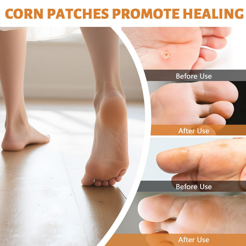 [Australia] - Corn Remover Pads for Feet & Toes: 40% Salicylic Acid Pads Extra Strength Treatment - Fast Effective Callus Remover & Friction Protection for Workers, Athletes, Seniors & Adults - 30pads 30 Count (Pack of 1) 
