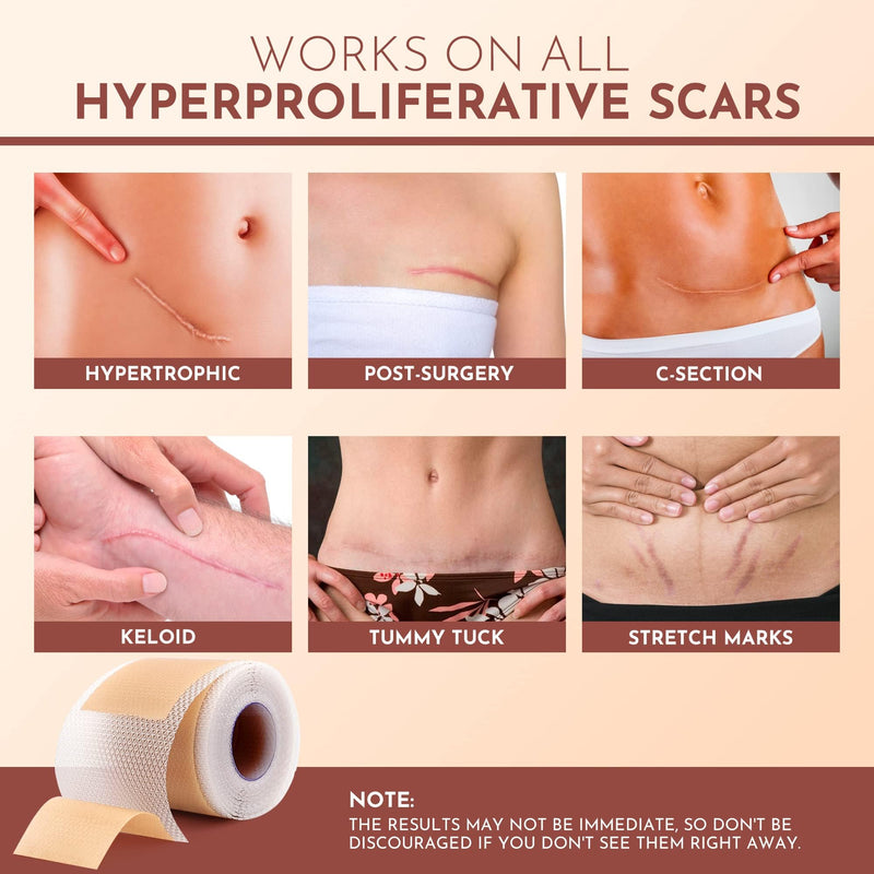 [Australia] - Silicone Scar Sheets - Silicone Scar Tape (1.6"x 120" Roll-3M) - keloid bump removal - Reusable And Effective Scar Removal Strips - Silicone Tape for Scars, Keloid, C-Section, Acne et 