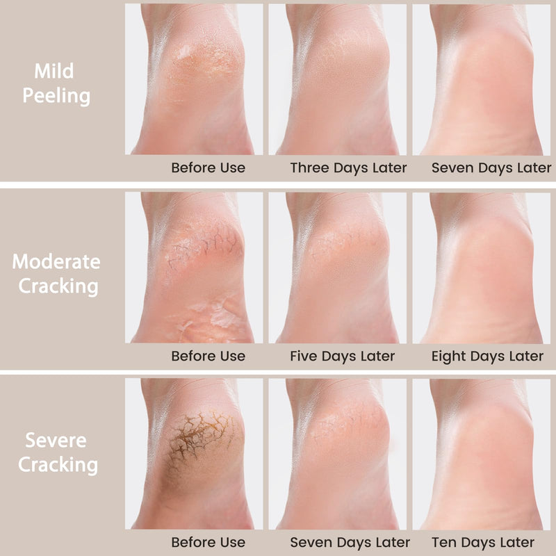[Australia] - 3 Packs Urea Cream 40 Percent - Foot & Hand Cream, for Dry, Cracked Heels, Feet, Knees, Elbows, and Hands, Callus Remover, Maximum Strength Urea Lotion for Softening and Moisturizing 5.29 Ounce (Pack of 3) 