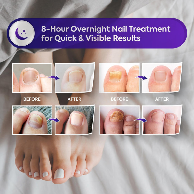 Toenail Fungus Treatment Extra Strength: Nail Fungus Treatment Patches for Toenail and Fingernails - 8-Hour Nighttime Renewal with 1% Tolnaftate - 32 Patches