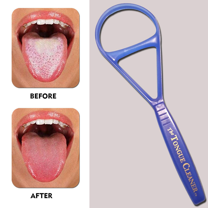 [Australia] - Tongue Scraper Cleaner - the Tongue Cleaner - End Bad Breath and Freshens Breath - Eliminate Bad Breath - Bad Breath Treatment (Color May Vary) Colors Will Vary 