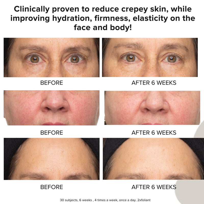 Skincare Peel and Scrub for Face and Body - Lactic Acid Retinol Vitamin C, E At-Home Microdermabrasion Anti-Irritant Dermatologist Tested