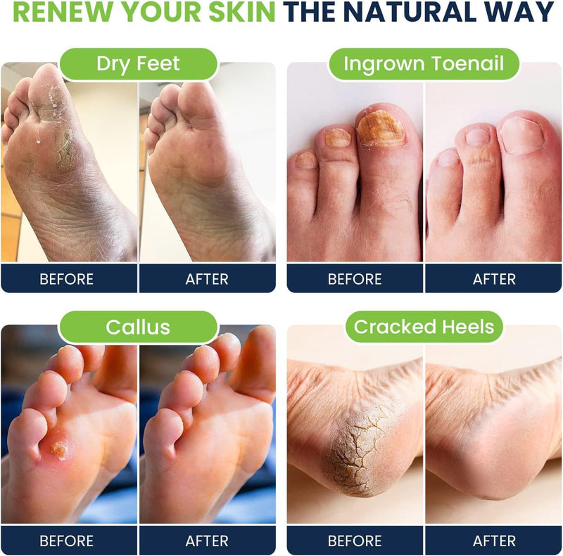 [Australia] - Tea Tree Oil Foot Soak with Epsom Salts for Foot Pain, Soreness, Athletes Foot - Odors Callus Remover for Feet with Extra Strength Gel & Foot Pumice Stone Set - Easy Way to Remove Hard Calluses 