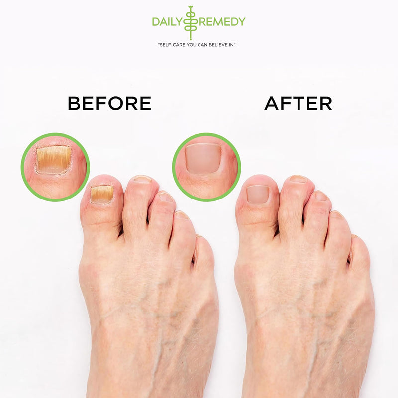 Tea Tree Oil Foot Soak with Epsom Salt - Made in USA - for Toenail irritations, Athletes Foot, Stubborn Foot Odor Scent, Softens Calluses & Soothes Sore Tired Feet - 16 Ounce Tea Tree Oil 1 Pound (Pack of 1)