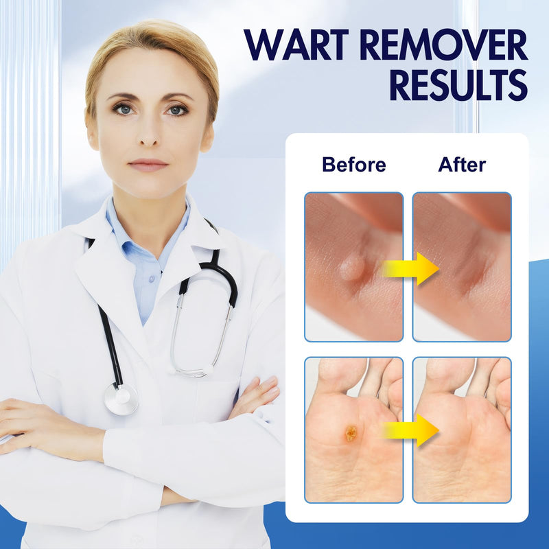 [Australia] - Bighero Wartss Corn Remover Maximum Strength Liquid with Salicylic Acid - Fast-Acting Wartsss Liquid Freeze Off Designed for Wartss, Plantar Wartss, Common Wartis, Flat Corn, Callus 