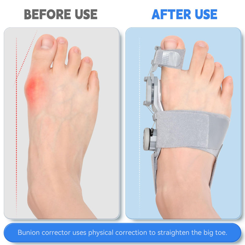[Australia] - Bunion Corrector for Women & Men,Adjustable Universal Size Bunion Splint, Big Toe Straightener, Bunion Fix Device with 2 Silicone Pads, Better Fit to the Toes Without Damaging the Skin(1PCS,Gray) Grey 