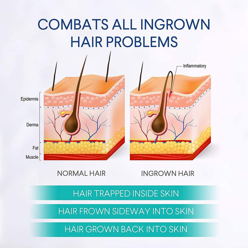 Razor Bumps Treatment for Women and Men, Ingrown Hair Treatment, Razor Bump Treatment for Bikini Area, Face, Neck, Legs, and Underarm Area, After Shave for Women and Men, Ingrown Hair Serum
