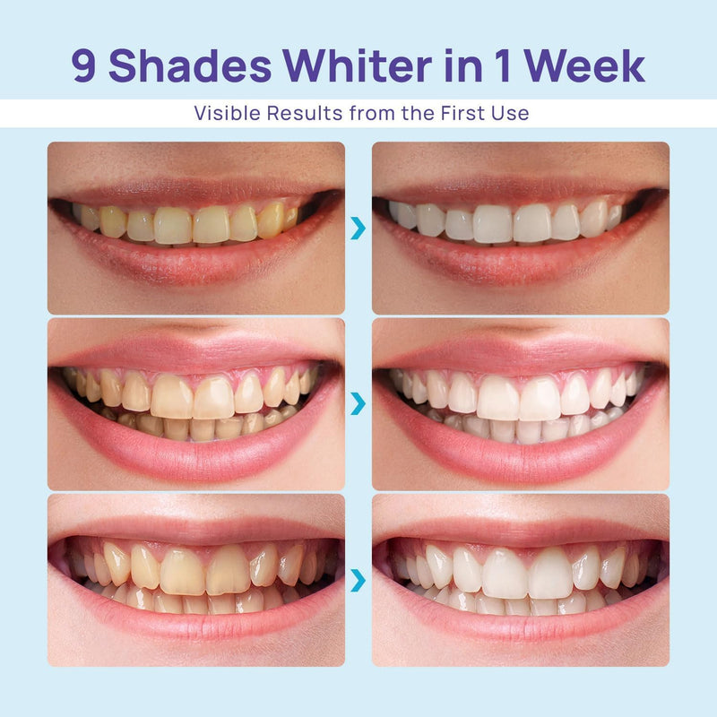 Whitebite Pro Teeth Whitening Kit for Sensitive Teeth – 32X LED Light + 35% Carbamide Peroxide Gel + Remineralizing Gel | Dental-Grade Whitening at Home