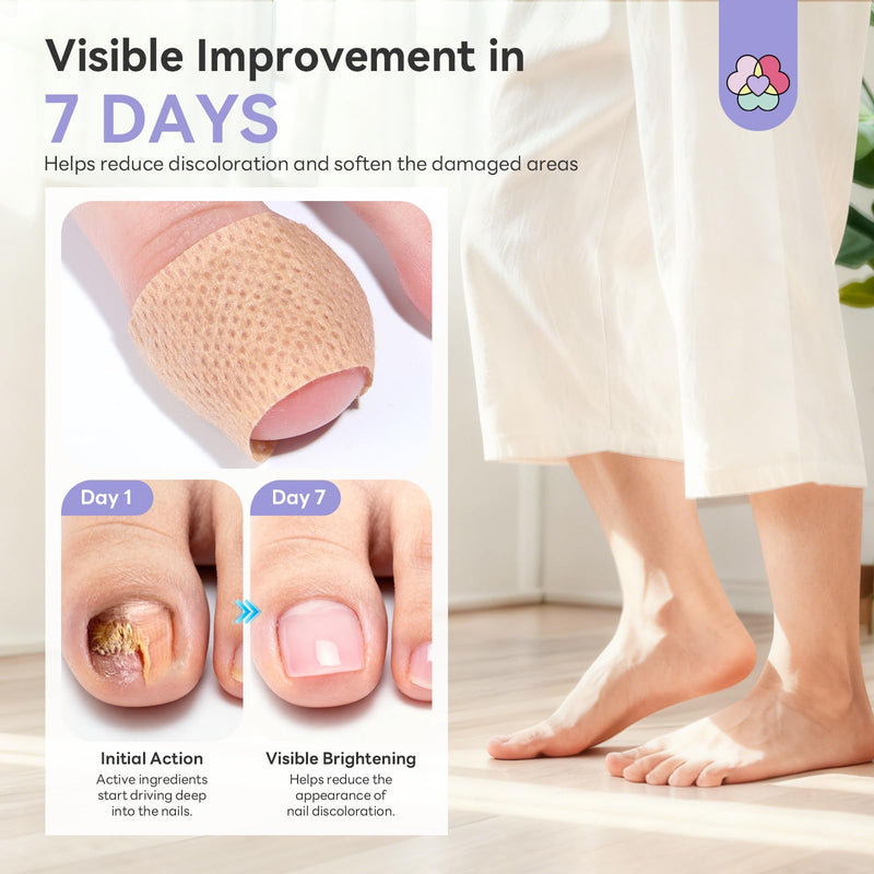 SAVILAND Fungal Nail Patches for Overnight 1% Tolnaftate Nail Repair 64Pcs | FSA-HSA, 8H Deep Overnight Repair, Reduces Yellow & Thick Nails, Breathable Materials Adhere Securely, Damaged Toenail Care 2 Pcs
