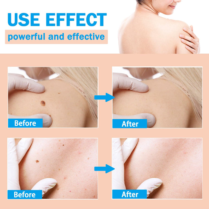 [Australia] - LIGUID WART Remover,Fast Action Wart Remover,Wart Liquid with Salicylic Acid, Plantar Wart, Common Wart, Flat Wart,Corn, Callus,1floz(30mL) 1 bottle 