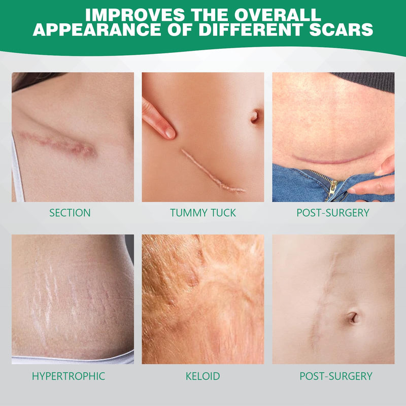 [Australia] - Silicone Plaster for Scars Scar Plaster Silicone Scar Tape Silicone Plaster for Scars Scar Tape Ultra Thin Soft and Breathable Suitable for Burns and Cesarean Section Scars (4 * 150 cm) 