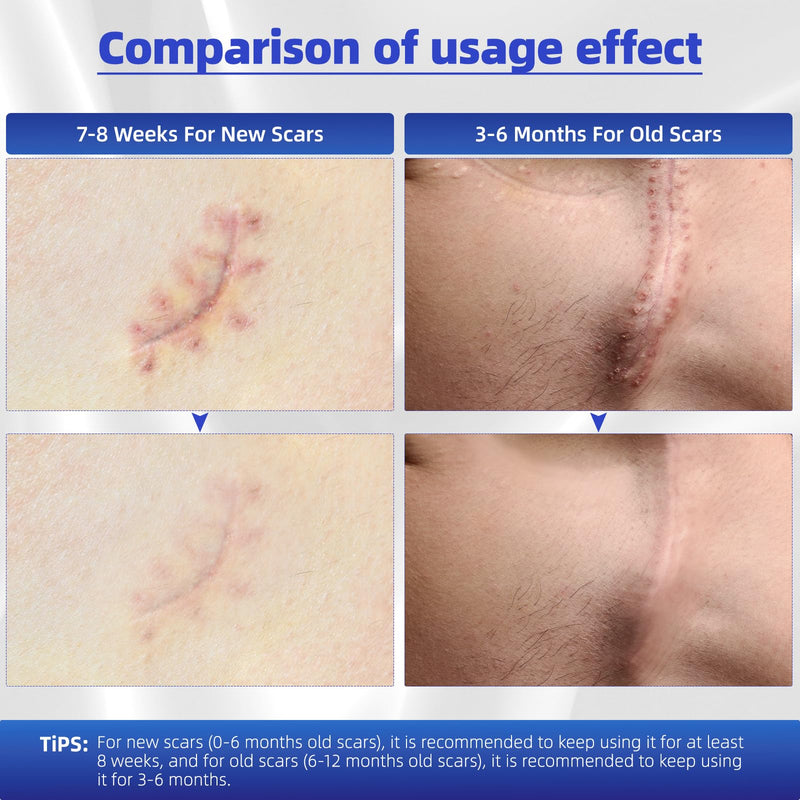 [Australia] - Scar ointment to reduce scar visibility, scar gel for old and new scars, scar cream for children & adults for burns to reduce scars (45g) odorless 