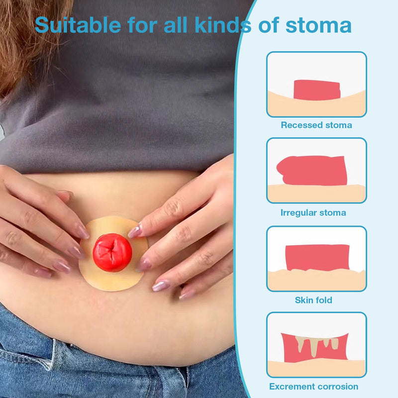 [Australia] - 20PCS Moldable Ostomy Barrier Rings, Elastic Skin Extender Rings, 2mm Thickness Medical Hydrocolloid Ostomy Bag Supplies, Better Seal No Leaking Skin Barrier Ring for Colostomy Bags 20 PCS 