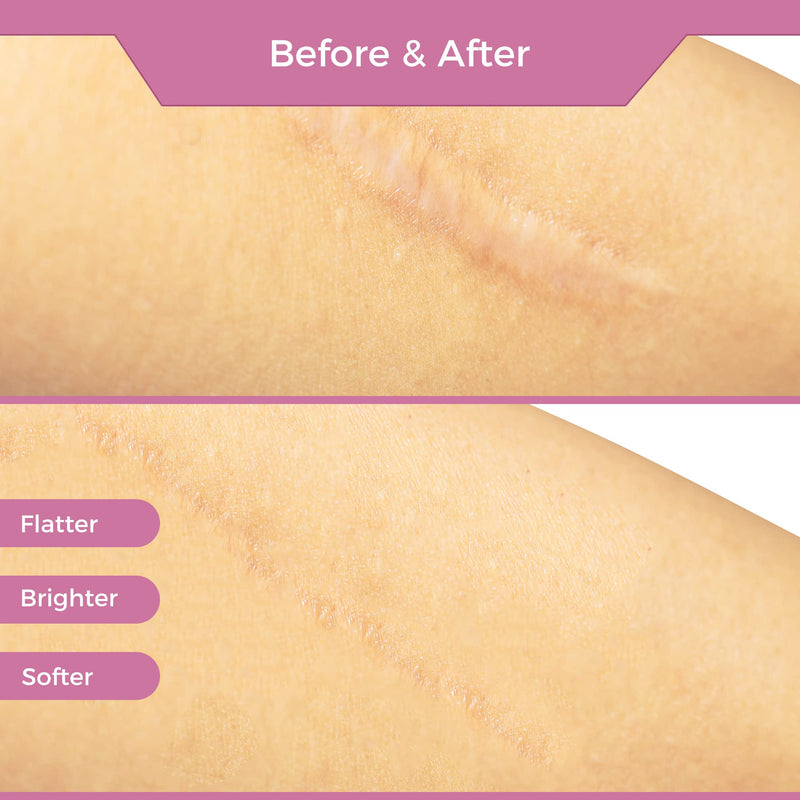 [Australia] - Silicone Scar Tape Scar Sheets - Professional Medical Grade Scar Removal Treatment, Non irritating, Painless for C-Section, Surgical Scars, Burn, Keloid, Acne(1.6” x 60” Roll) 4x150cm 