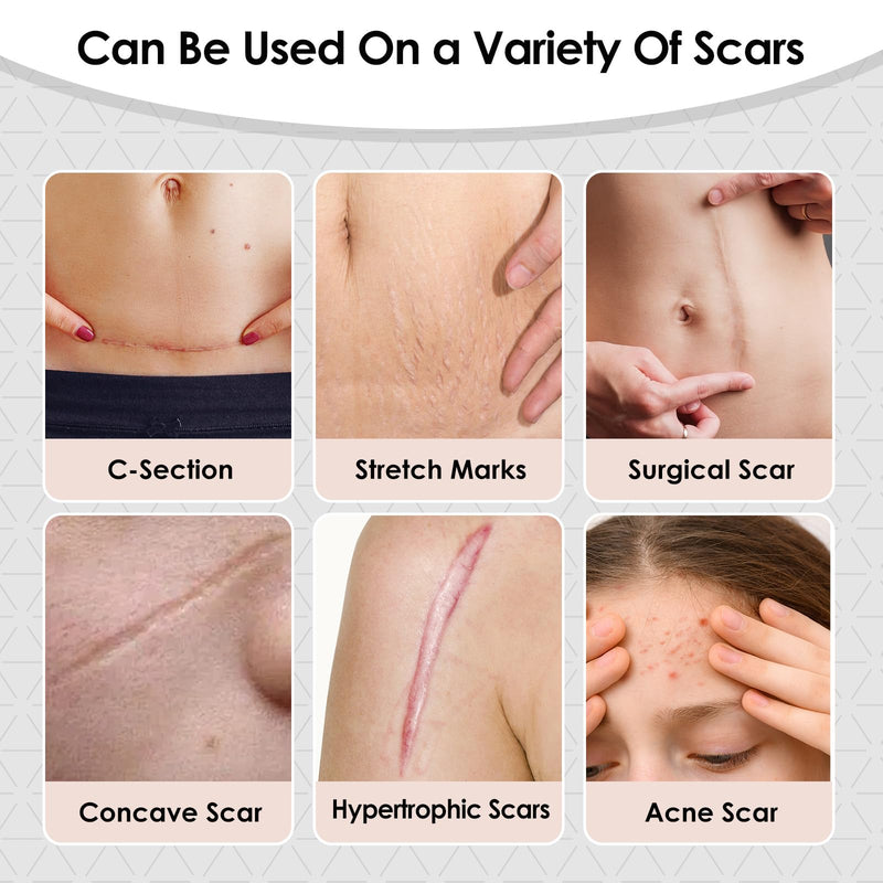 [Australia] - Silicone Scar Sheets,Silicone Scar Tape for Removal Treatment,Medical Grade Scar Tape for Surgical Scars,C-Section,Tummy Tuck,Scar Removal Away(1.6" x 60" Roll - 1.5M) Keloid Bump RemovalÔºå1PC 1.6" x 60" Roll - 1.5M 