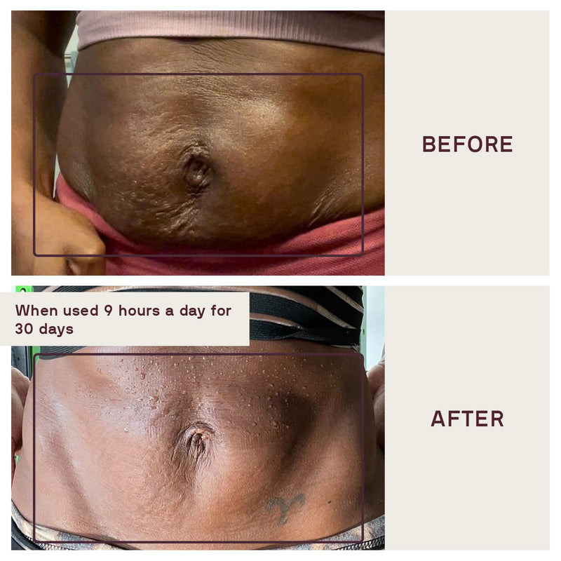 [Australia] - Dermaclara Silicone Body Patch to Prevent and Treat Stretch Marks - Pregnancy Safe Skin Care Silicone Patches for Scars - Stretch Mark Prevention Pregnancy Must Haves - 5" x 5" x .07" 
