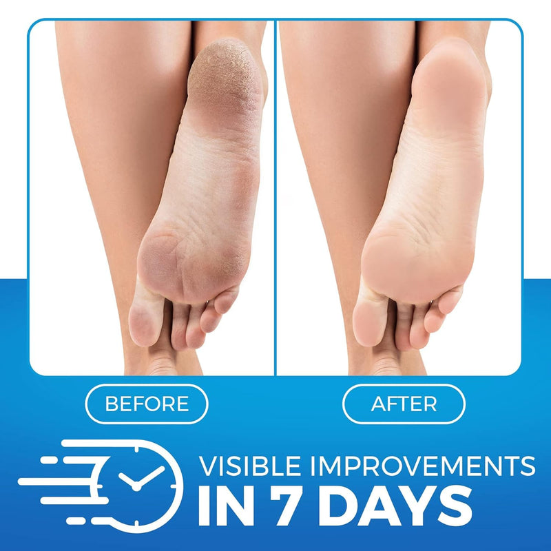 [Australia] - Imperial Feet Urea Foot Balm - Natural Urea Cream for Foot Care, Cracked Heel Repair, Rough Skin, Dryness, Calluses - Cleansing, Exfoliant - Wild Herb Extract - 5.07oz 