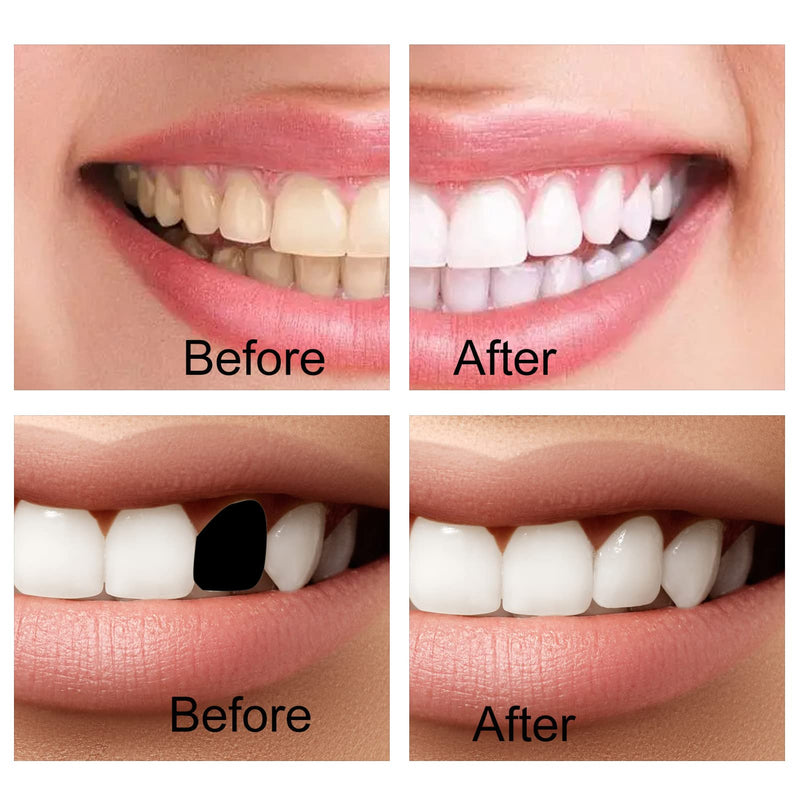 [Australia] - QincLing 2 pairs of false teeth veneers, temporary teeth, artificial teeth, dentures, false teeth, dentures, white temporary dentures with tooth repair beads, teeth, cosmetic tooth cover 
