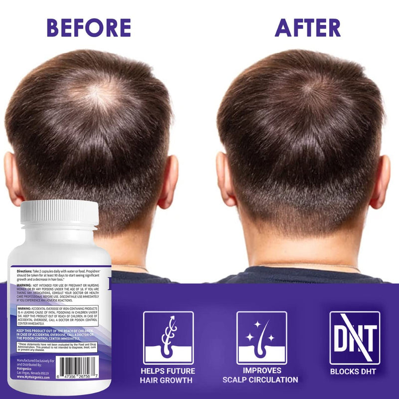 Propidren DHT Blocker & Hair Growth Pills To Stop Hair Loss and Regrow Hair | Hair Vitamins for Men & Women, Regrowth, DHT Blocking, Thinning Hair, Excessive Shedding, Scalp Support, 30 Day Supply