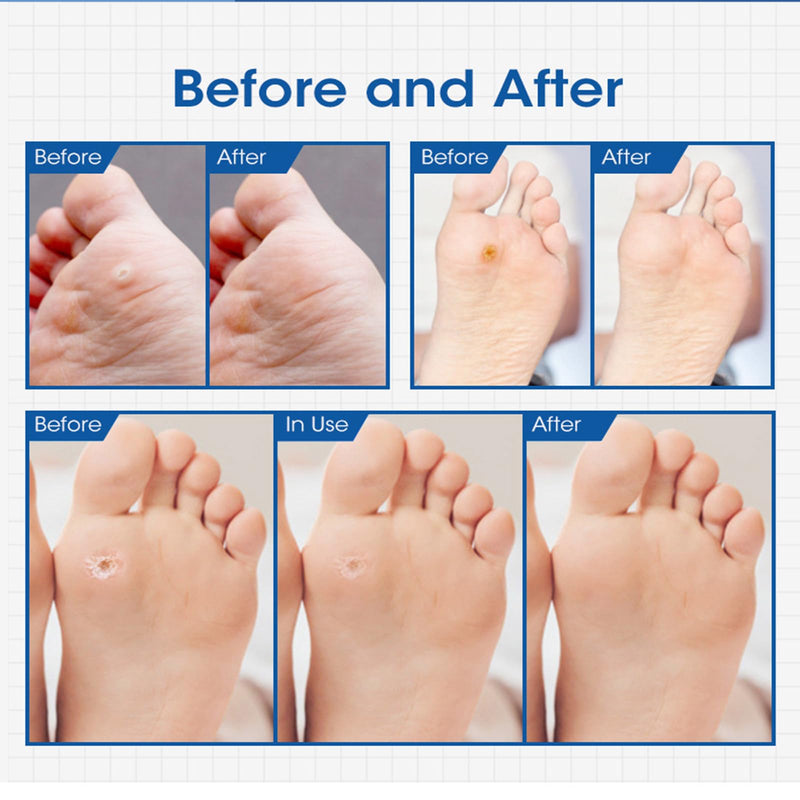 [Australia] - Corn Remover,Corn Removers for Feet Extra Strength,24 Pack Removes Corns Fast (24pcs) 24pcs 