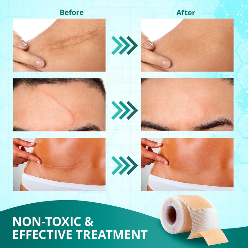 [Australia] - Silicone Scar Sheets, Silicone Scar Tape (1.6"x 60" Roll-1.5M), Reusable and Effective Scar Removal Sheets, Silicone Scar Removal Sheets for Surgical Scars, Healing Keloid, C-Section, Tummy Tuck 