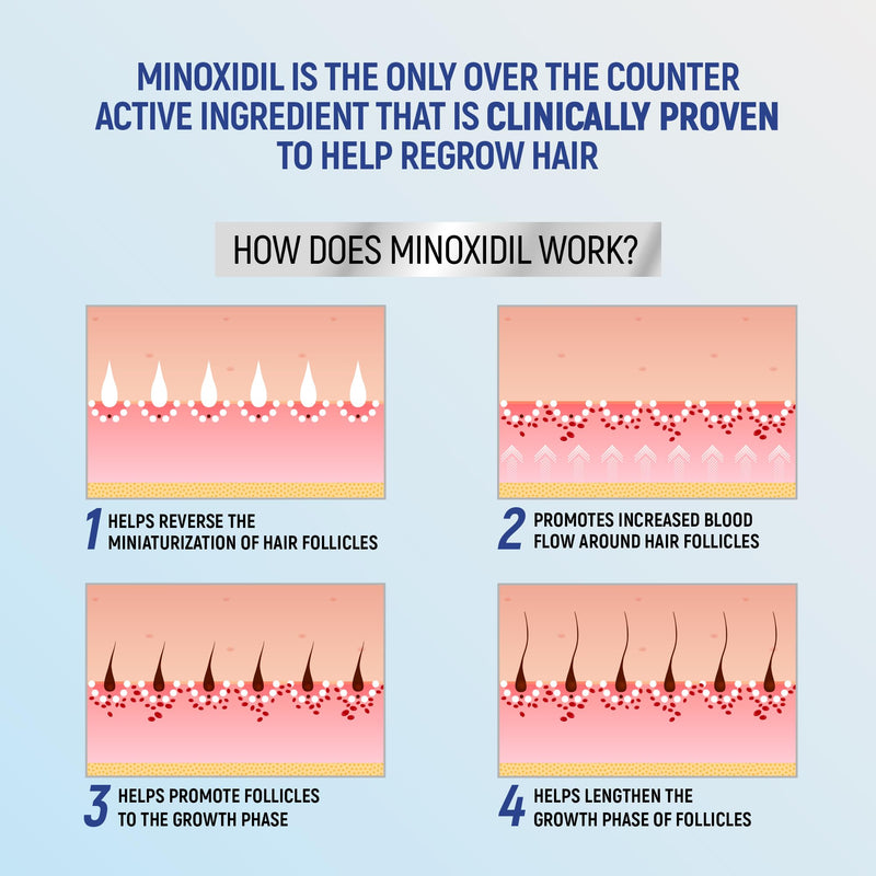Minoxidil 5% Topical Aerosol Foam, Hair Regrowth 4 Months Treatment for Men, 2.11 oz (4 Pack) 2.11 Ounce (Pack of 4)