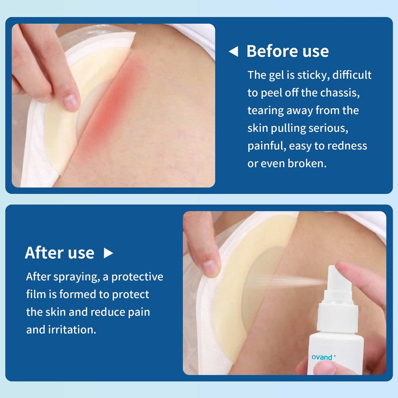 [Australia] - No Sting Ostomy Barrier Spray - Skin Barrier Film for Sensitive Skin - Skin Barrier for Protection Around Stomas and Wounds 