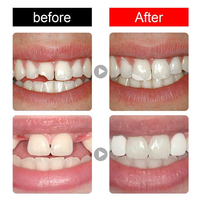 [Australia] - Temporary Tooth Cap Crown Veneer Front and Back Front and Back Teeth with Tooth Repair Thermal Beads Cap Filler for Missing Broken Teeth (50pcs Front Teeth and 50pcs) 